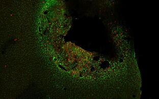 The picture shows how the cells of a brain tumour (glioma cells) and microglia communicate with each other.