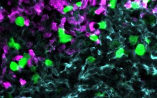 Die gegen CXCR5 gerichteten CAR-T-Zellen (grün) greifen Lymphom-Zellen (rot) innerhalb des Stroma-Zellnetzwerks im B-Zell-Follikel an (hellblau).